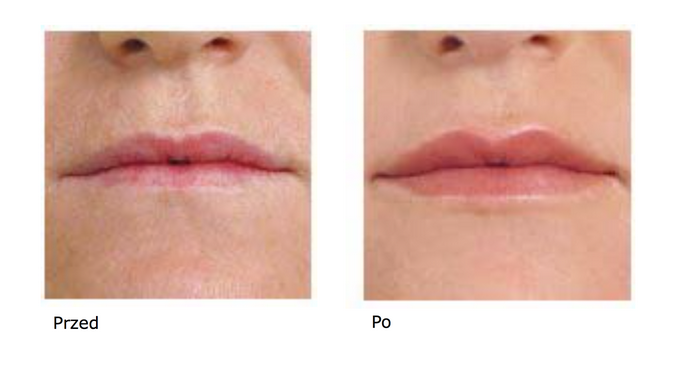 Zmarszczki nie muszą Cię ograniczać